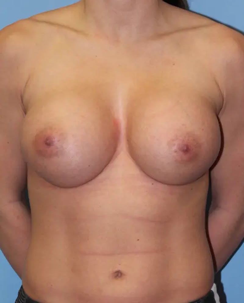 Breast Augmentation Before & After Gallery - Patient 364876 - Image 2