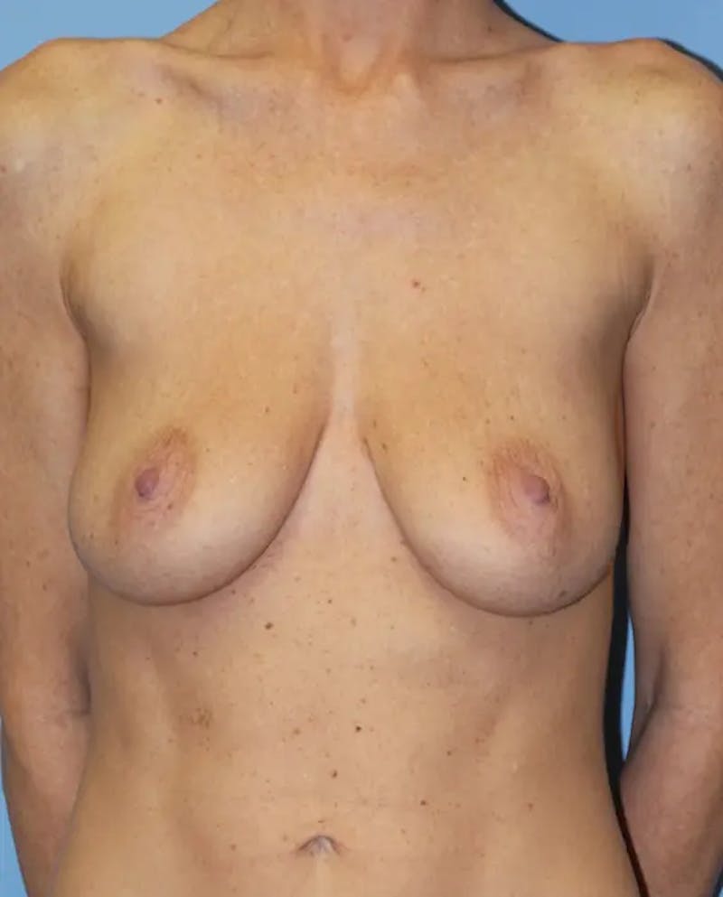 Breast Augmentation Before & After Gallery - Patient 119267 - Image 1
