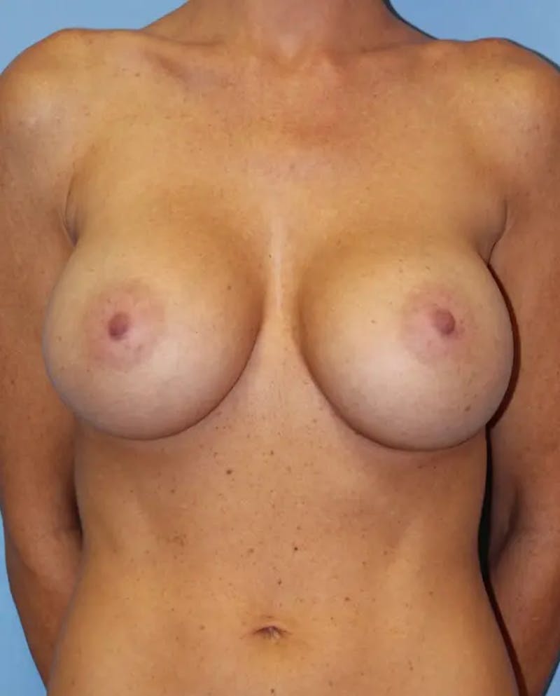 Breast Augmentation Before & After Gallery - Patient 119267 - Image 2