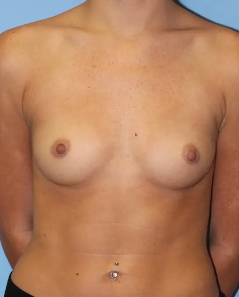 Breast Augmentation Before & After Gallery - Patient 314469 - Image 1