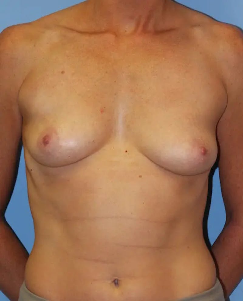 Breast Augmentation Before & After Gallery - Patient 388216 - Image 1