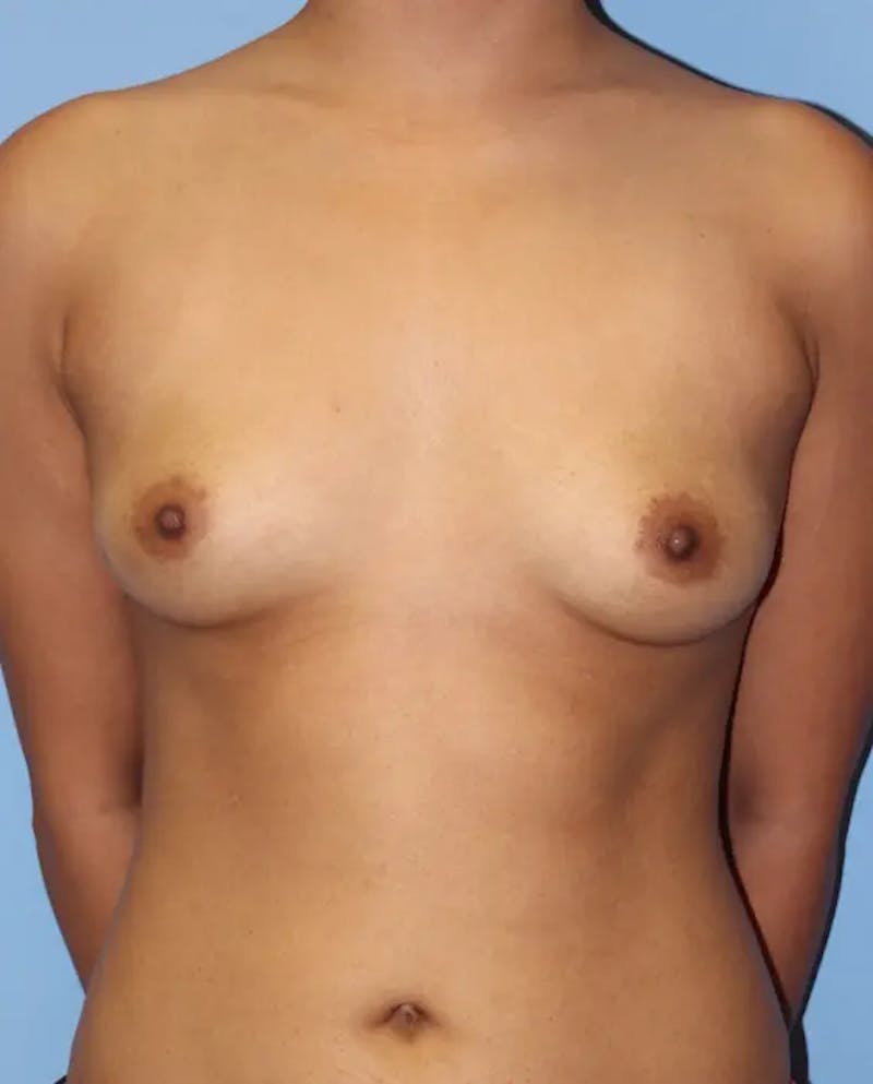 Breast Augmentation Before & After Gallery - Patient 149103 - Image 1