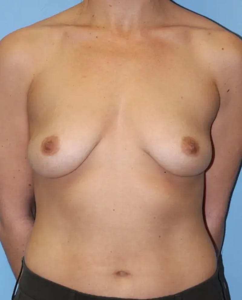 Breast Augmentation Before & After Gallery - Patient 221821 - Image 1