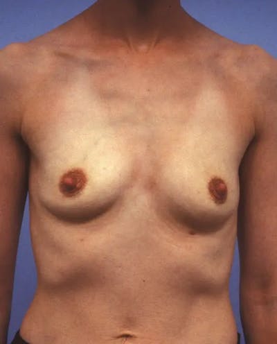 Breast Augmentation Before & After Gallery - Patient 243002 - Image 1