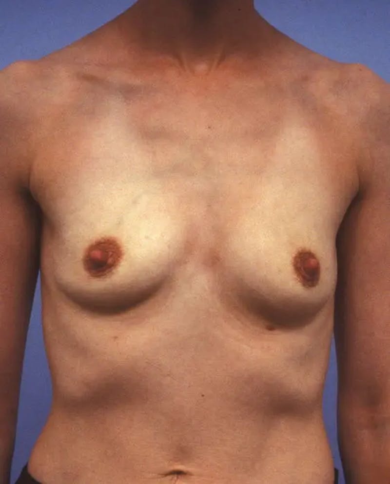 Breast Augmentation Before & After Gallery - Patient 243002 - Image 1