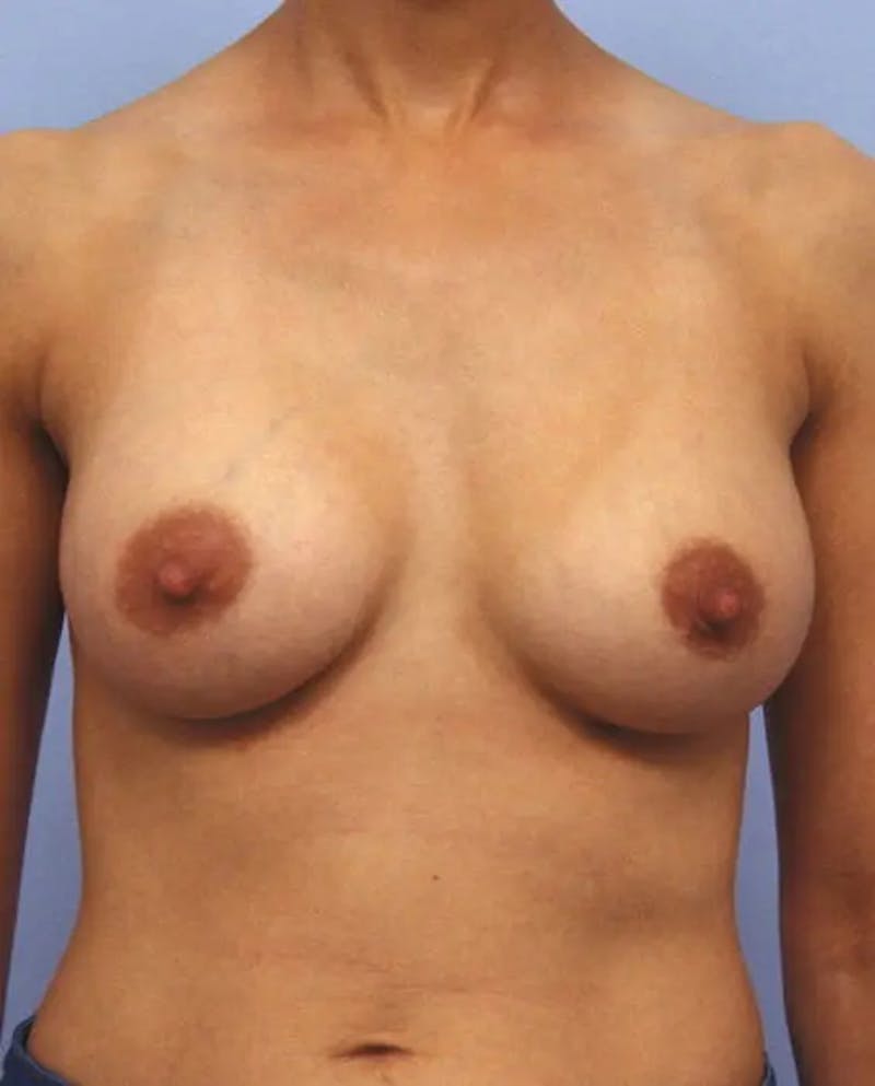 Breast Augmentation Before & After Gallery - Patient 243002 - Image 2