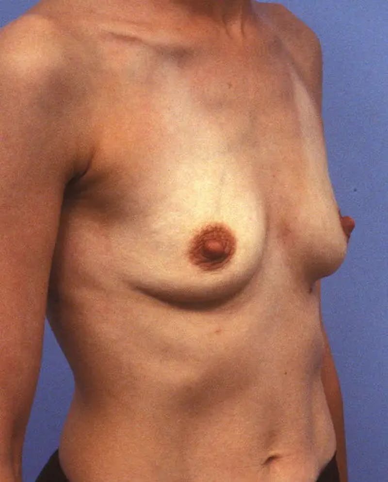 Breast Augmentation Before & After Gallery - Patient 243002 - Image 3