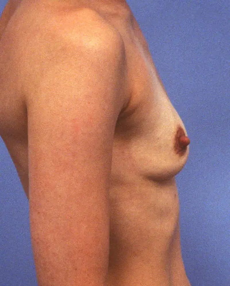 Breast Augmentation Before & After Gallery - Patient 243002 - Image 5