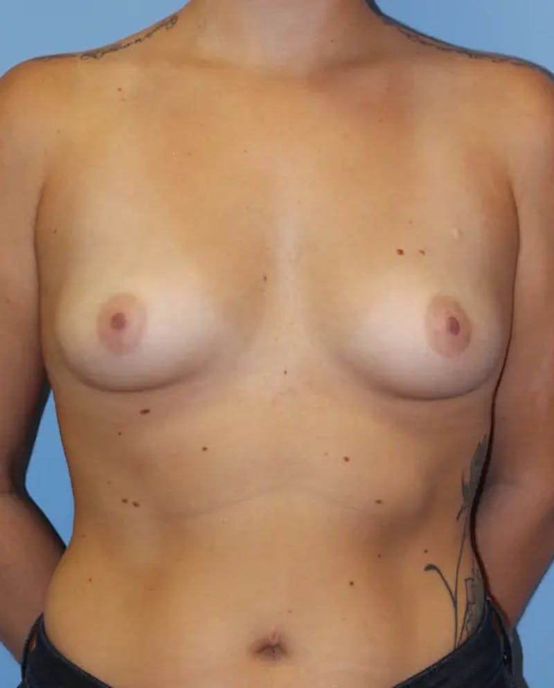 Breast Augmentation Before & After Gallery - Patient 114675 - Image 1