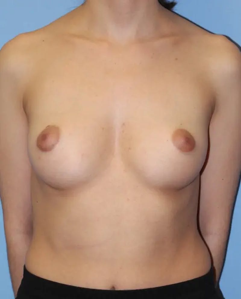 Breast Augmentation Before & After Gallery - Patient 549649 - Image 1