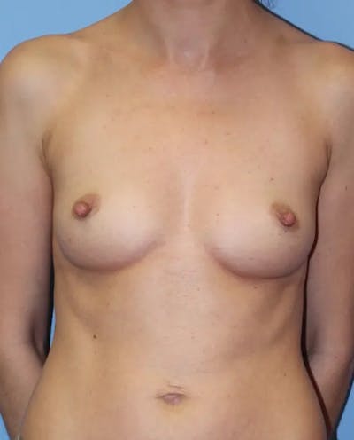 Breast Augmentation Before & After Gallery - Patient 338776 - Image 1