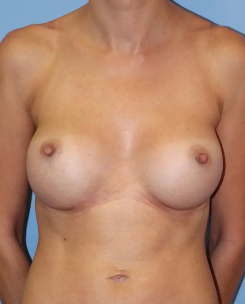 Breast Augmentation Before & After Gallery - Patient 338776 - Image 2