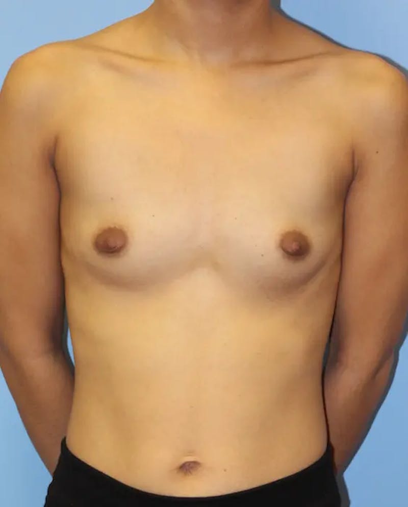 Breast Augmentation Before & After Gallery - Patient 101336 - Image 1