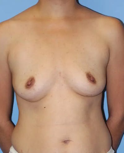 Breast Augmentation Before & After Gallery - Patient 130665 - Image 1
