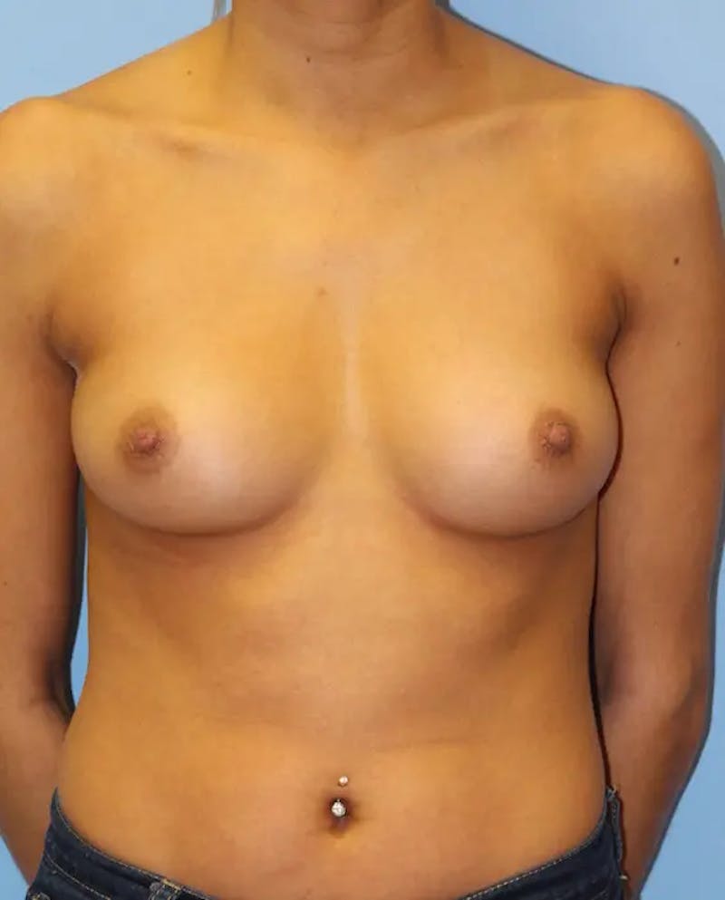 Breast Augmentation Before & After Gallery - Patient 373728 - Image 1