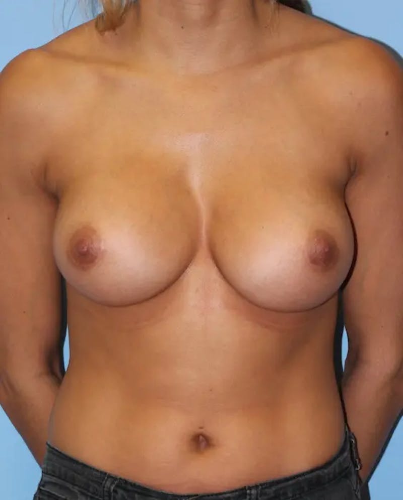 Breast Augmentation Before & After Gallery - Patient 373728 - Image 2