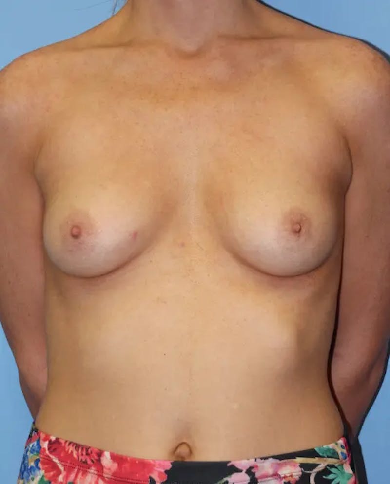 Breast Augmentation Before & After Gallery - Patient 845220 - Image 1