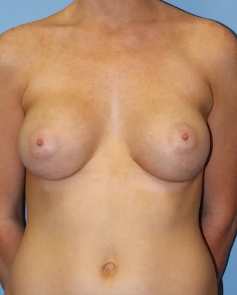 Breast Augmentation Before & After Gallery - Patient 845220 - Image 2