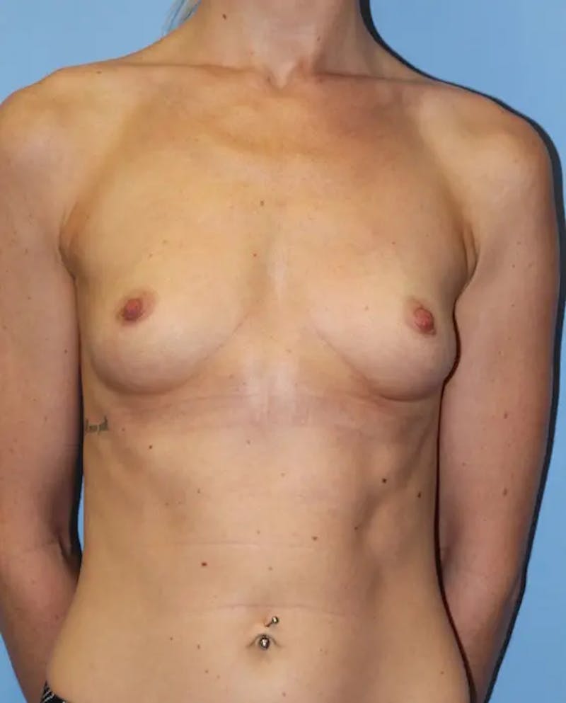 Breast Augmentation Before & After Gallery - Patient 398238 - Image 1