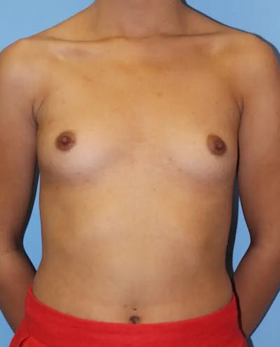 Breast Augmentation Before & After Gallery - Patient 191614 - Image 1
