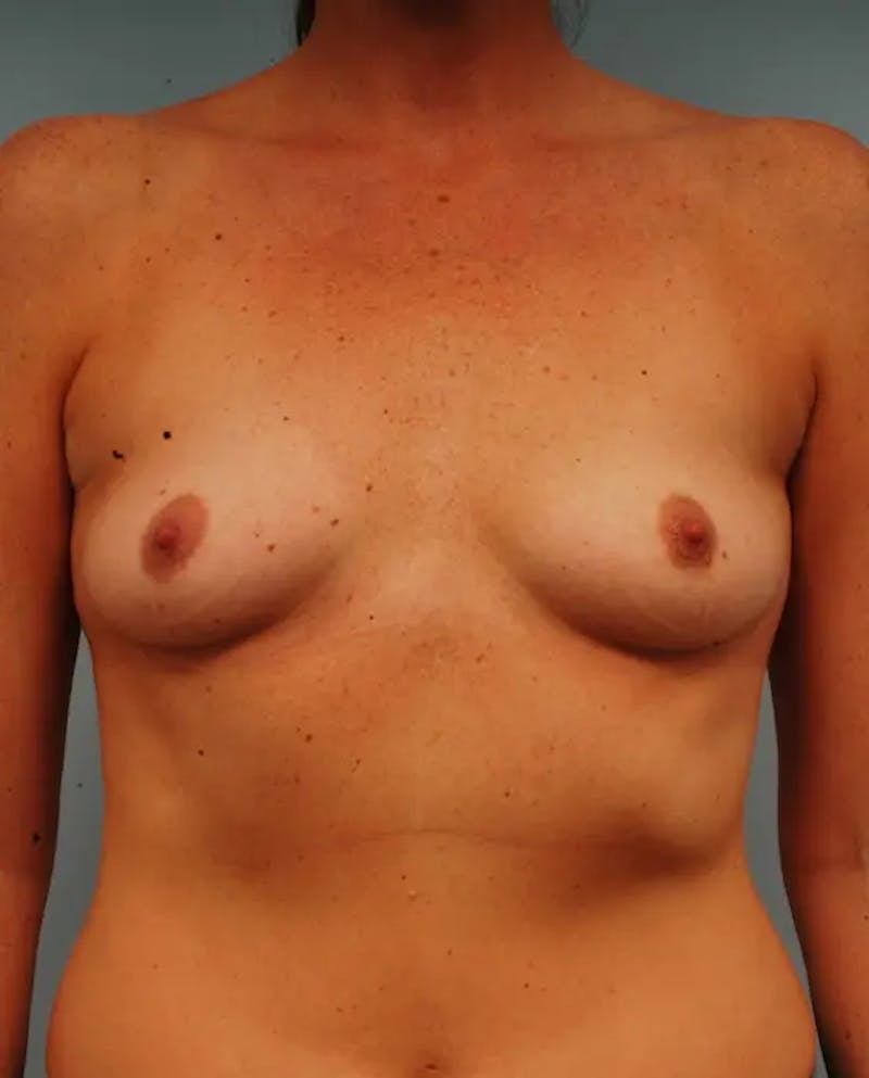 Breast Augmentation Before & After Gallery - Patient 962679 - Image 1