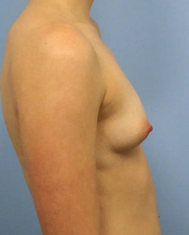 Breast Augmentation Before & After Gallery - Patient 802092 - Image 5