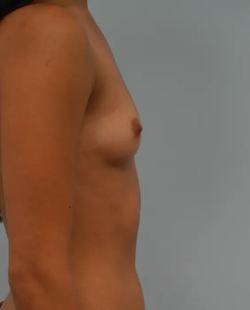 Breast Augmentation Before & After Gallery - Patient 136504 - Image 5