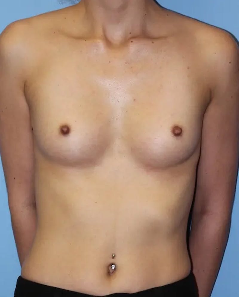 Breast Augmentation Before & After Gallery - Patient 255740 - Image 1