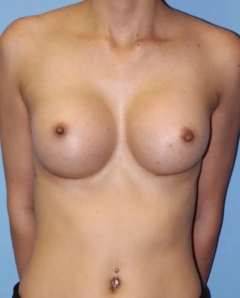 Breast Augmentation Before & After Gallery - Patient 255740 - Image 2