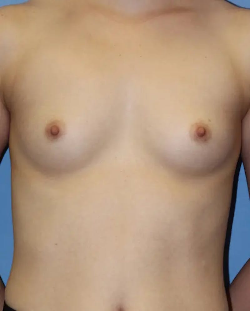 Breast Augmentation Before & After Gallery - Patient 169779 - Image 1