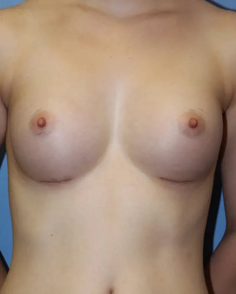 Breast Augmentation Before & After Gallery - Patient 169779 - Image 2