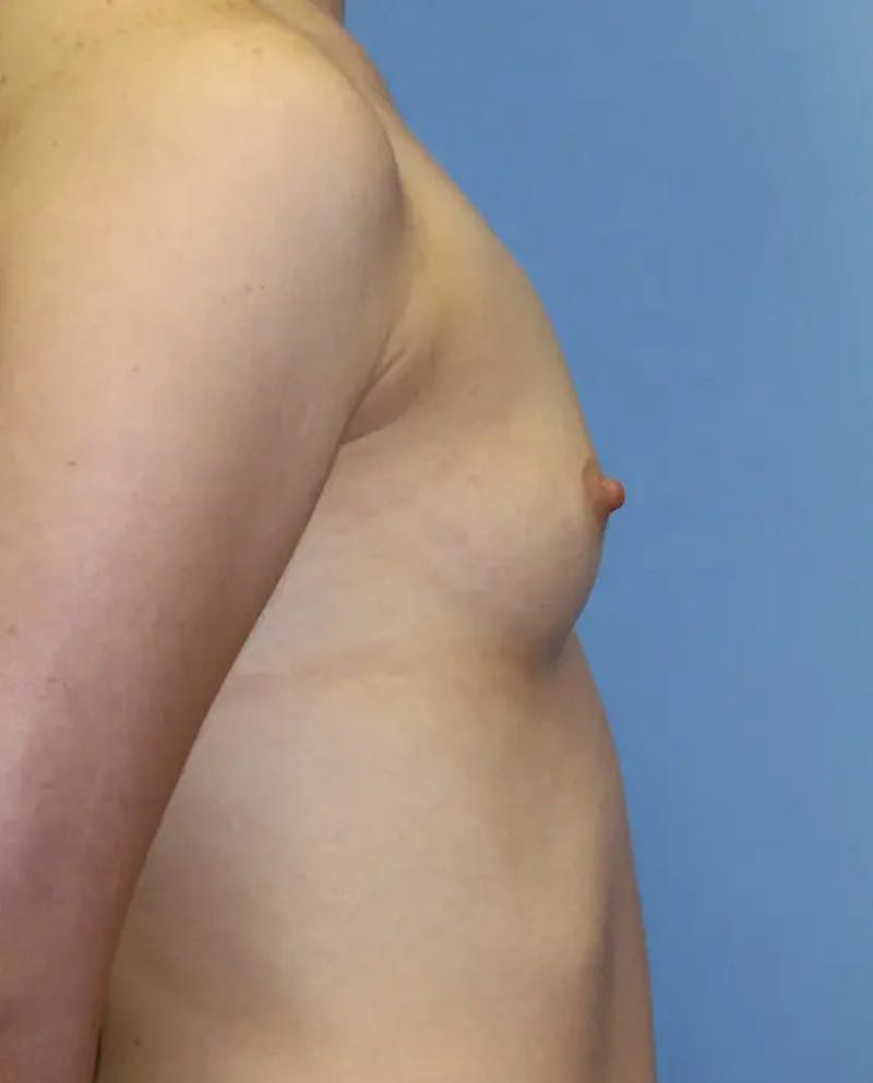 Breast Augmentation Before & After Gallery - Patient 169779 - Image 5