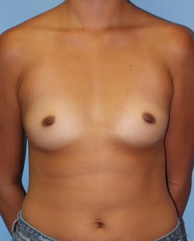 Breast Augmentation Before & After Gallery - Patient 394953 - Image 1