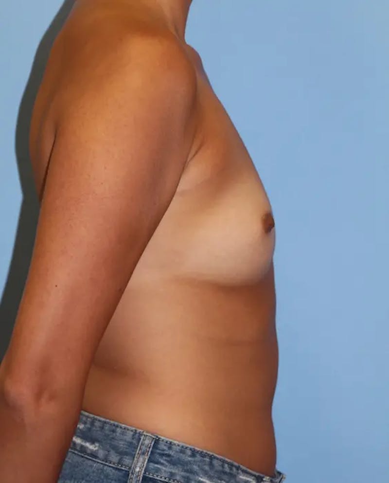 Breast Augmentation Before & After Gallery - Patient 394953 - Image 5