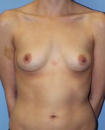 Breast Augmentation Before & After Gallery - Patient 371488 - Image 1