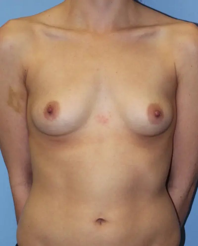 Breast Augmentation Before & After Gallery - Patient 371488 - Image 1