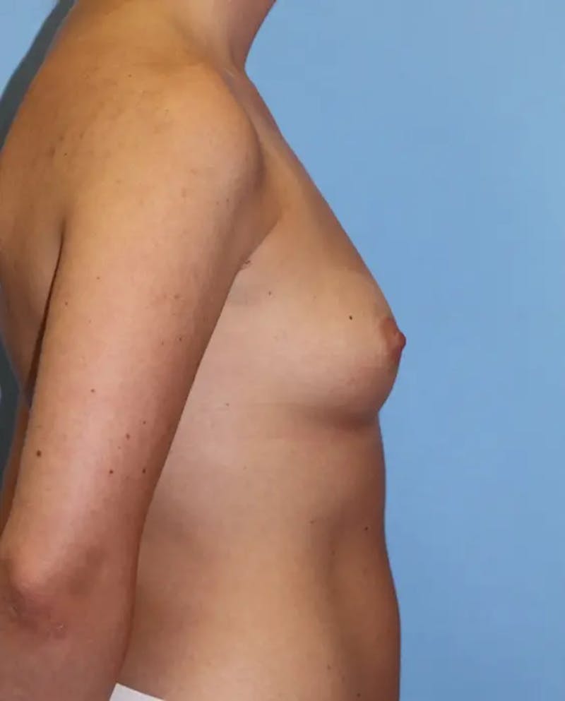 Breast Augmentation Before & After Gallery - Patient 375911 - Image 5