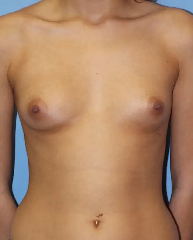 Breast Augmentation Before & After Gallery - Patient 223013 - Image 1