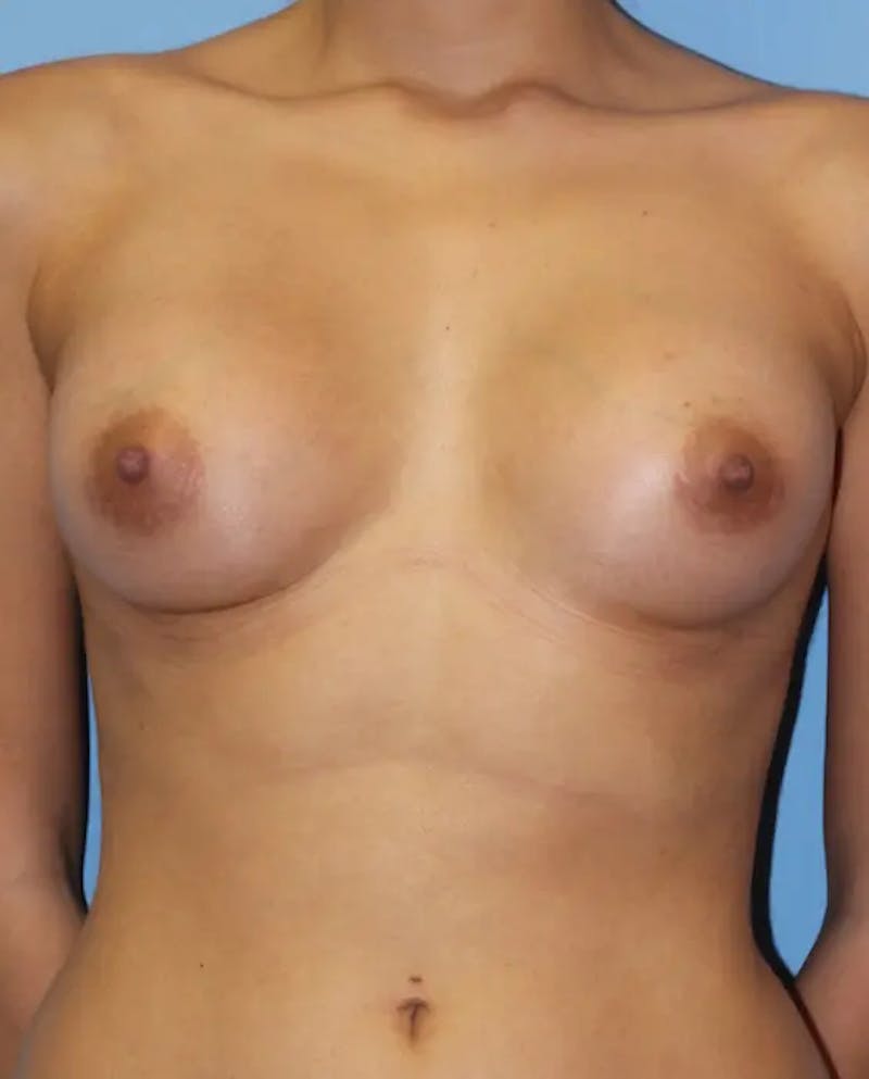 Breast Augmentation Before & After Gallery - Patient 223013 - Image 2