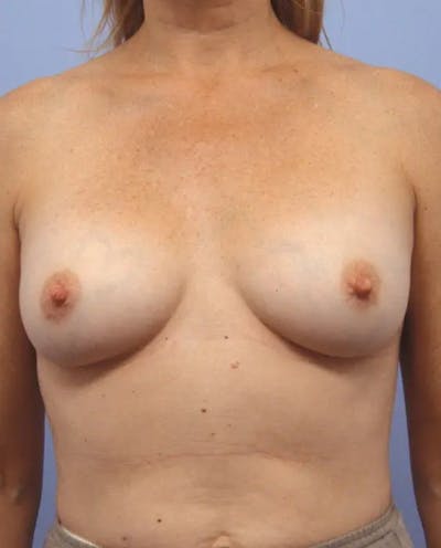 Breast Augmentation Before & After Gallery - Patient 349641 - Image 1