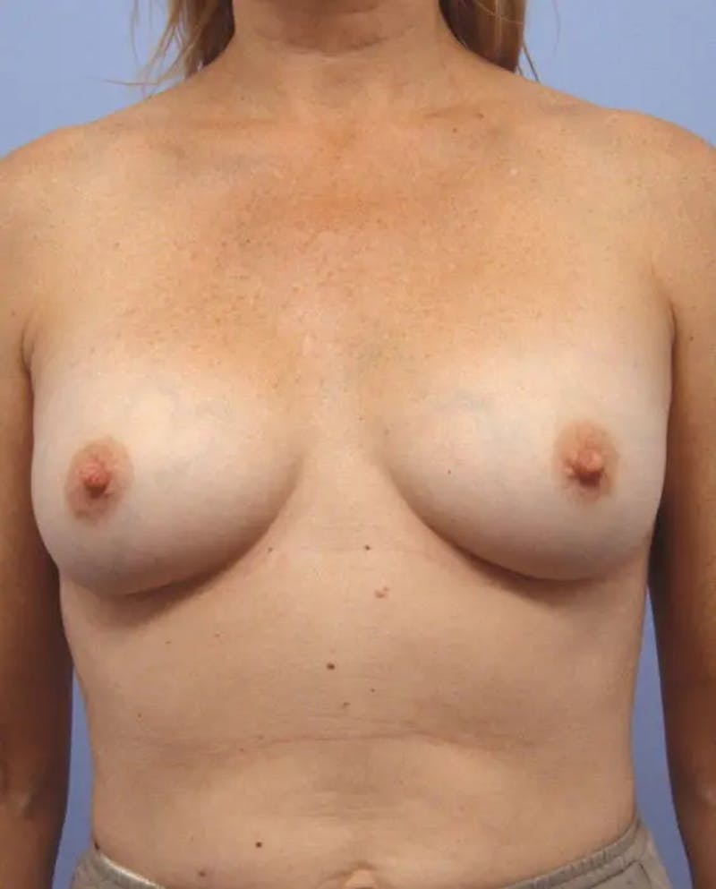 Breast Augmentation Before & After Gallery - Patient 349641 - Image 1