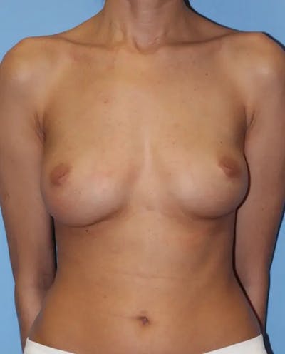 Breast Augmentation Before & After Gallery - Patient 333457 - Image 1