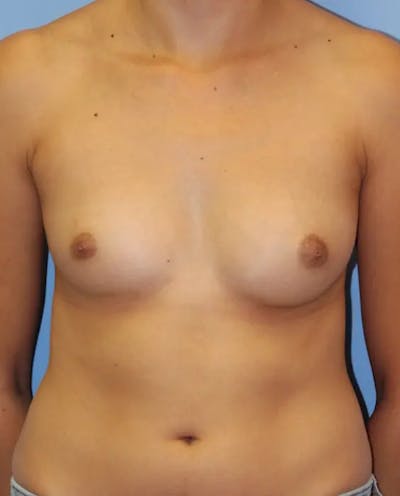 Breast Augmentation Before & After Gallery - Patient 315387 - Image 1