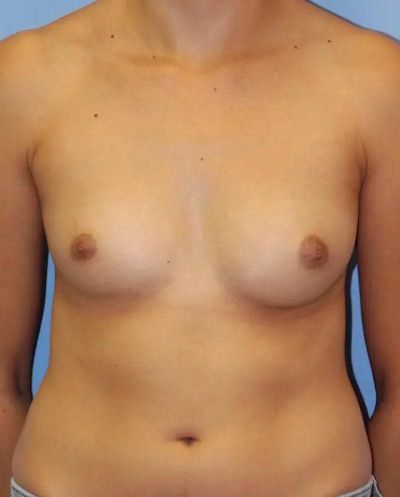 Breast Augmentation Before & After Gallery - Patient 315387 - Image 1