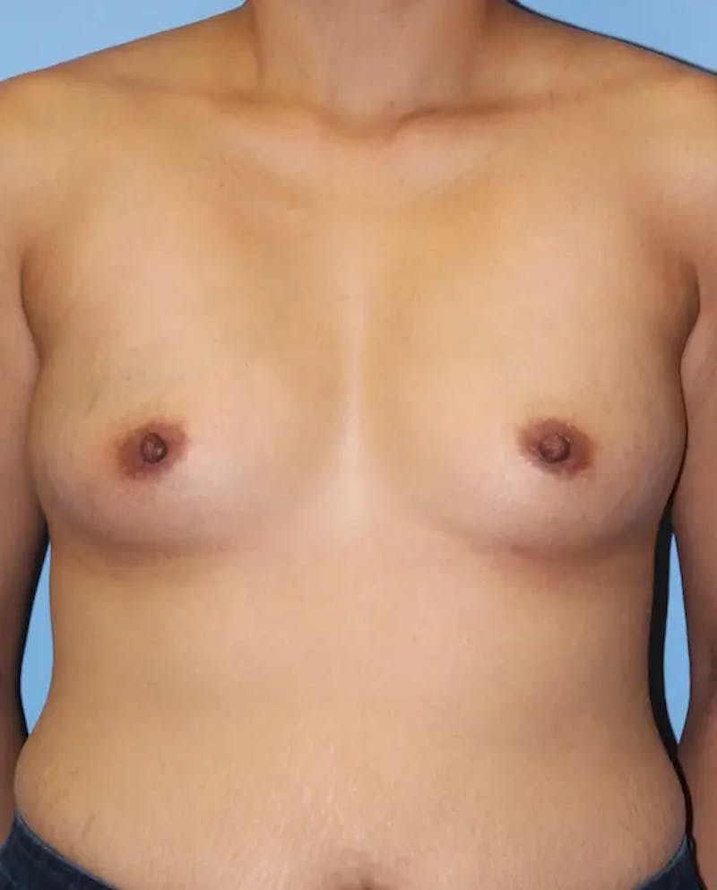 Breast Augmentation Before & After Gallery - Patient 213084 - Image 1