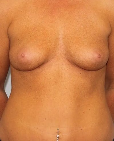 Breast Augmentation Before & After Gallery - Patient 162233 - Image 1