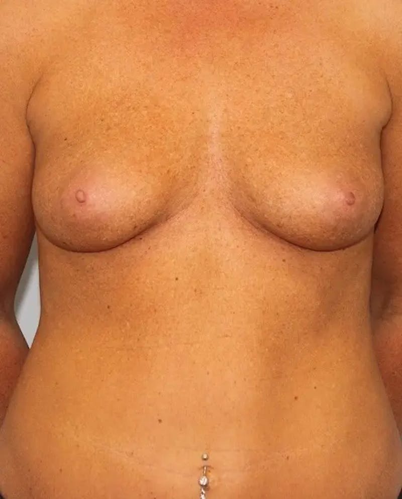 Breast Augmentation Before & After Gallery - Patient 162233 - Image 1