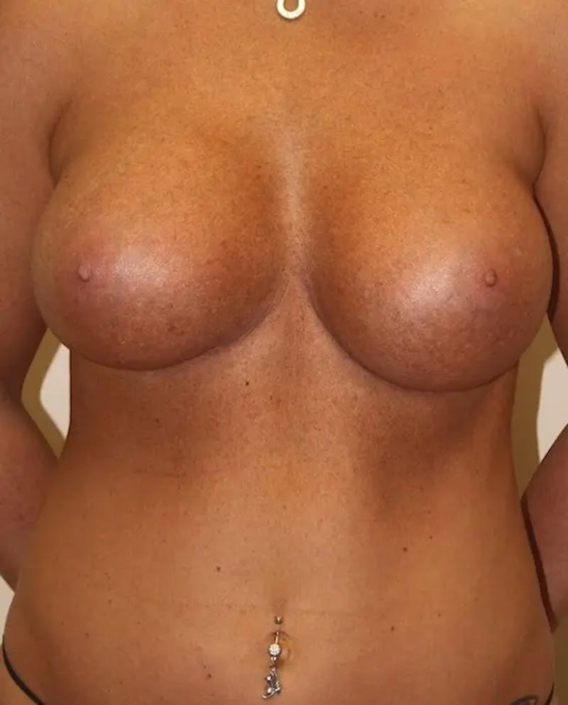 Breast Augmentation Before & After Gallery - Patient 162233 - Image 2