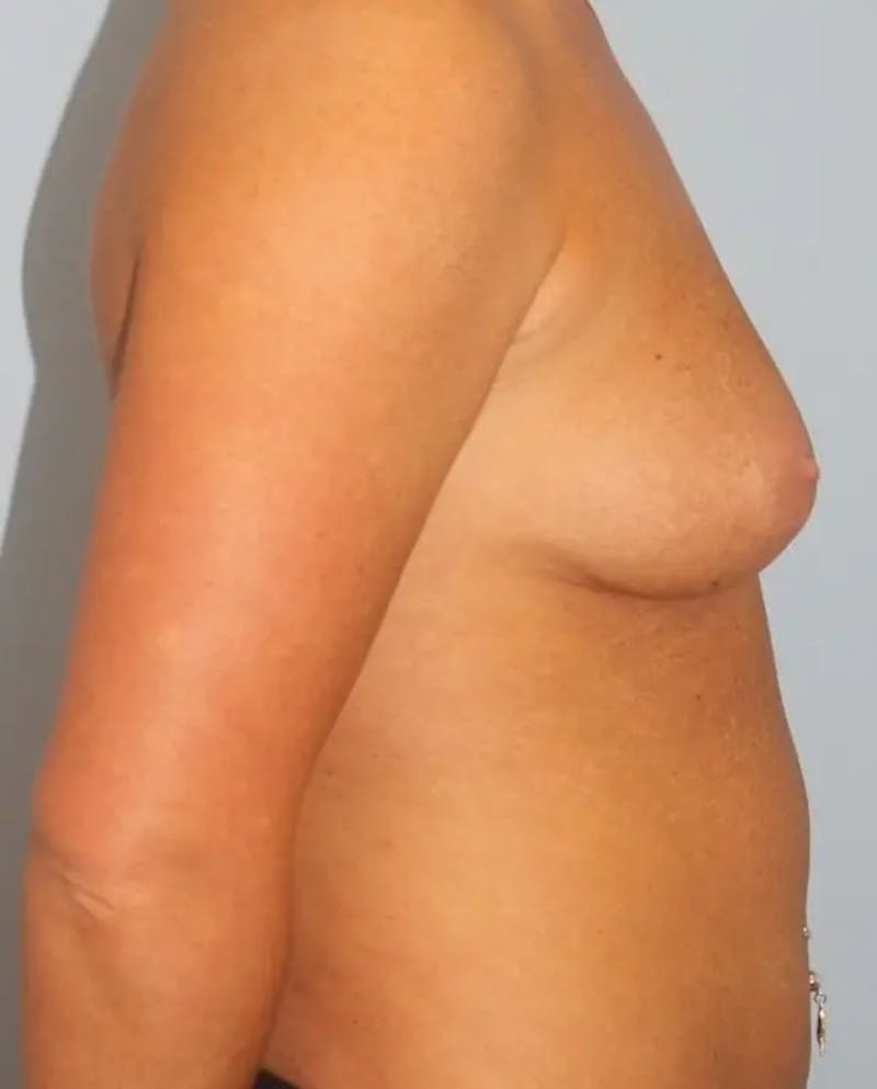 Breast Augmentation Before & After Gallery - Patient 162233 - Image 5