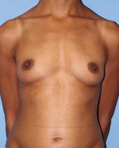 Breast Augmentation Before & After Gallery - Patient 420721 - Image 1